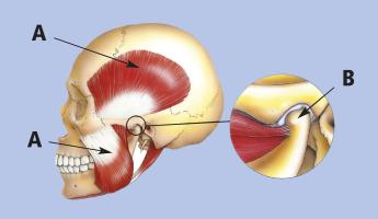 plaats waar pijnklachten in het kaakgewricht zitten