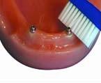 met de tandenborstel het implantaat van het ondergebit reinigen
