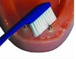 met tandenborstel reinigen van het implantaat in de onderkaak