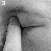 Het oog sluiten en met de vinger de ooghoek de traanbuis dichtdrukken