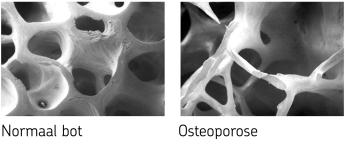 Een doorsnede van een stukje gezond bot; hierbij zijn de gaatjes klein. Daarnaast een doorsnede van bot met osteoporse; in dit bot zijn de gaatjes veel groter.