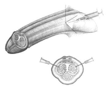 plaatje van penis met uitleg waar je moet injecteren