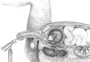 doorsnede onderlichaam waarop katheter via penis naar nier gaat