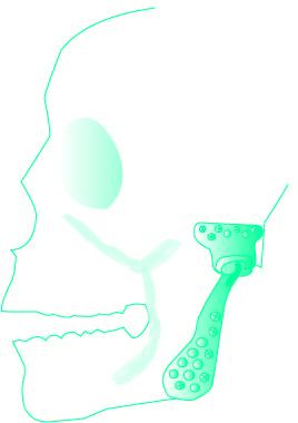 Blauwe schedel met kaakgewricht prothese vanaf de gehoorgang tot en met de onderkaak