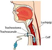 doorsnede van luchtpijp met stoma en canule