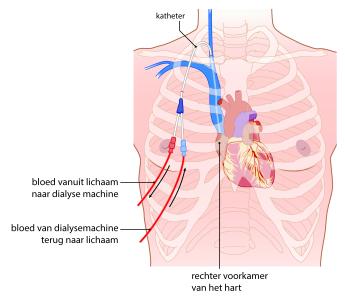 hemodialyse