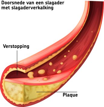 Foto: Doorsnede van een slagader met slagaderverkalking