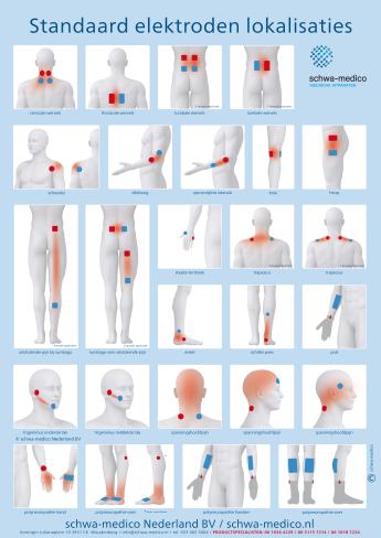 Op de afbeelding is te zien op welke plekken op het lichaam de elektroden van het TENS apparaat aangebracht kunnen worden.