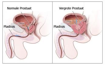 Afbeelding vergrote prostaat