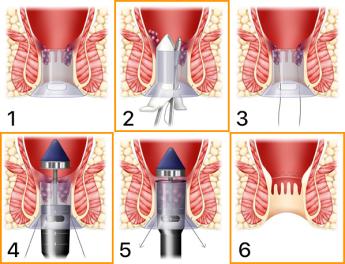 PPH-methode