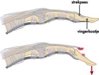 Gescheurde strekpees bij mallet vinger