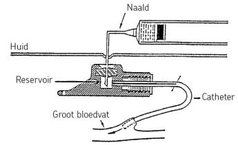 Gebruik infuuspoort