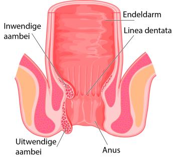 Endeldarm met uitwendige en inwendige aambei