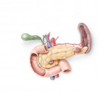 Alvleesklier voor het verwijderen van de pancreasstaart