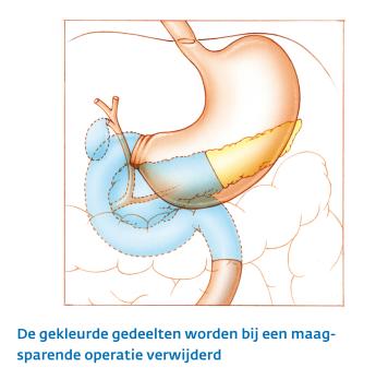 Alvleesklier maagsparende operatie