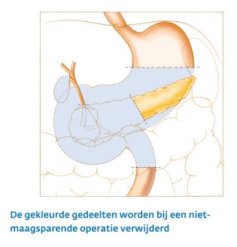 Alvleesklier na niet maagsparende operatie