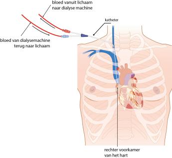 Afbeelding: tijdelijke dialyse katheter