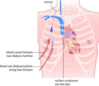 Een getunnelde dialyse katheter