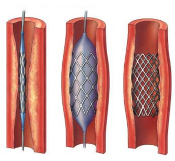 het inbrengen van een stent 