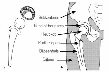 De plaats van de heupprothese