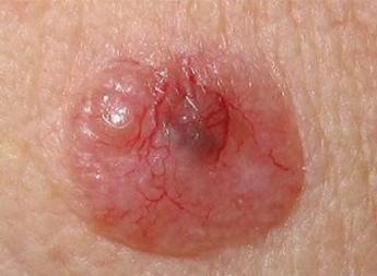 Basaalcelcarcinoom, een huidkleurig of roze, glazig en symmetrisch bultje 