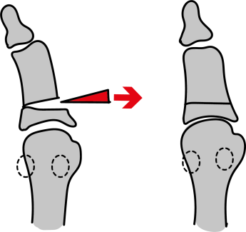 Hallux Valgus - operatie Akin techniek