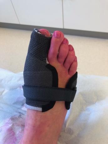 spalk na operatie hallux valgus