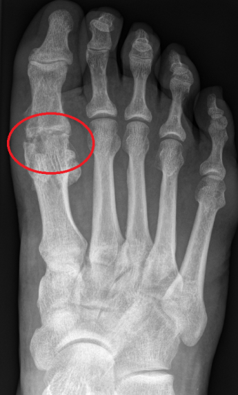 Röntgenfoto van voet met hallux rigidus 