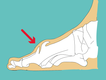 hallux rigidus - voor de cheilectomie operatie