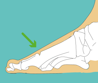 hallux rigidus - na de cheilectomie operatie