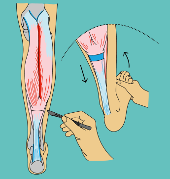 Operatie verlenging achillespees - gastroc slide