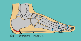 hielspoor peesplaat