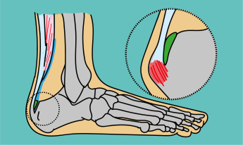 achillespees pijnlijke aanhechting