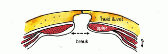 Littekenbreuk voor behandeling via riva stoppa techniek