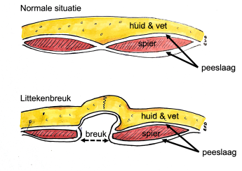 Littekenbreuk