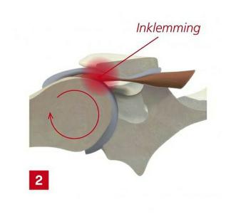 Inklemming schoudergewricht