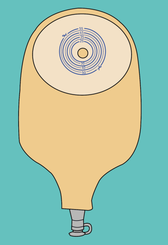 eendelig urinestoma