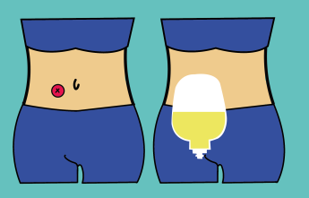 De plaats van het urinestoma, met en zonder stomazakje