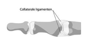 Vingerletsel volaire plaat