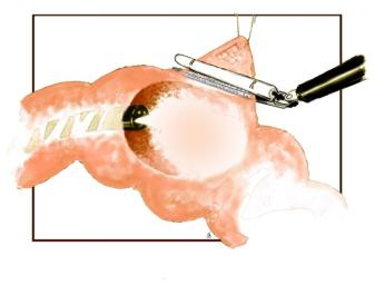 Plaatje coloscopisch geassisteerde wigresectie 