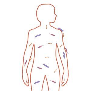 illustratie van persoon met bacterie over hun hele lichaam