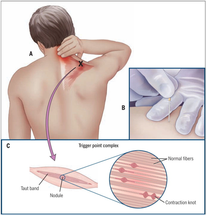 Afbeelding van de pijnplek, de behandeling en de spiervezels.