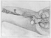 plaatje van een flexibele cystoscoop bij een man ingebracht