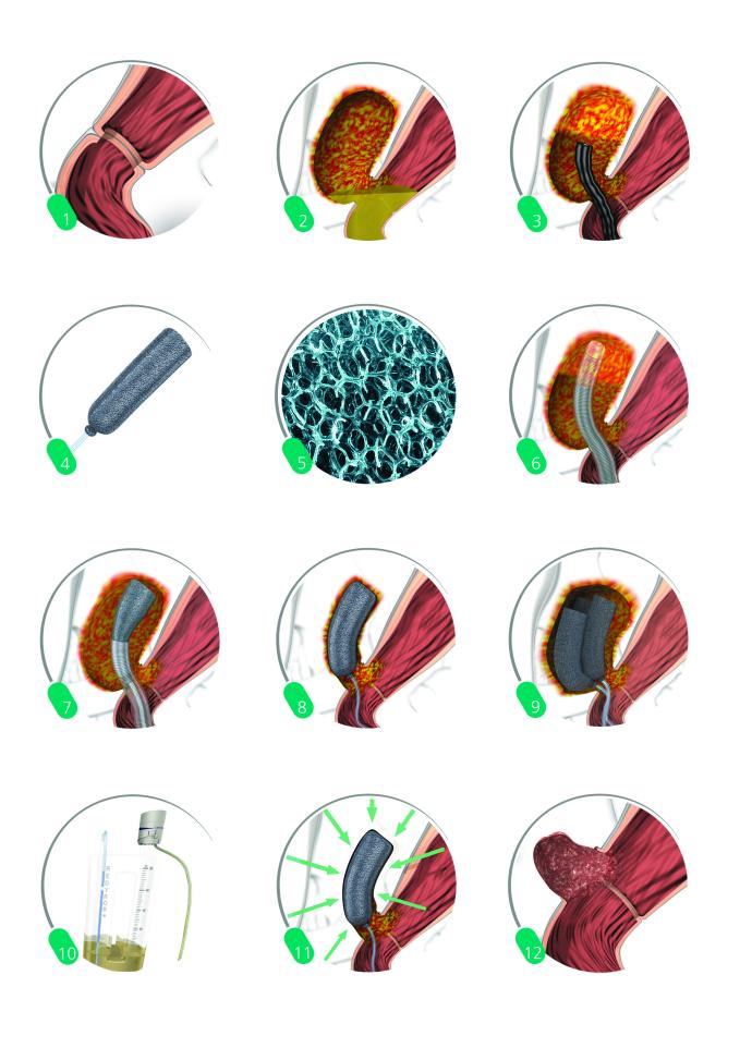 Endosponge behandeling