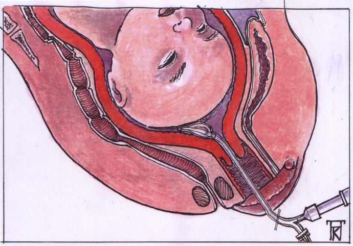 inbrengen van de ballonkatheter in de baarmoeder
