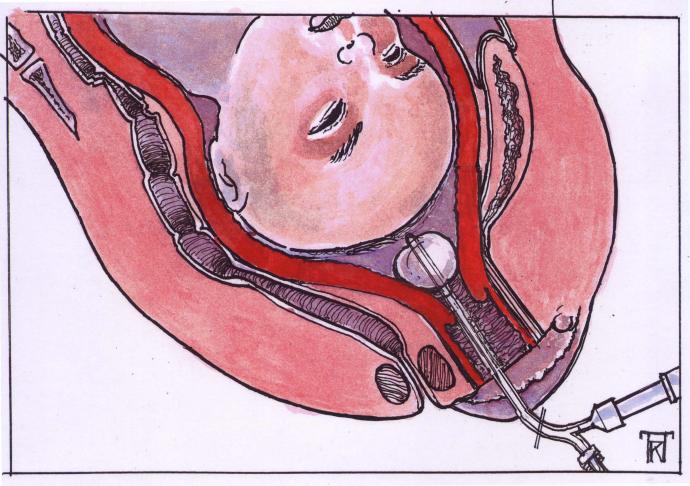 inbrengen van de ballonkatheter in de baarmoeder waarbij de ballon opgeblazen is