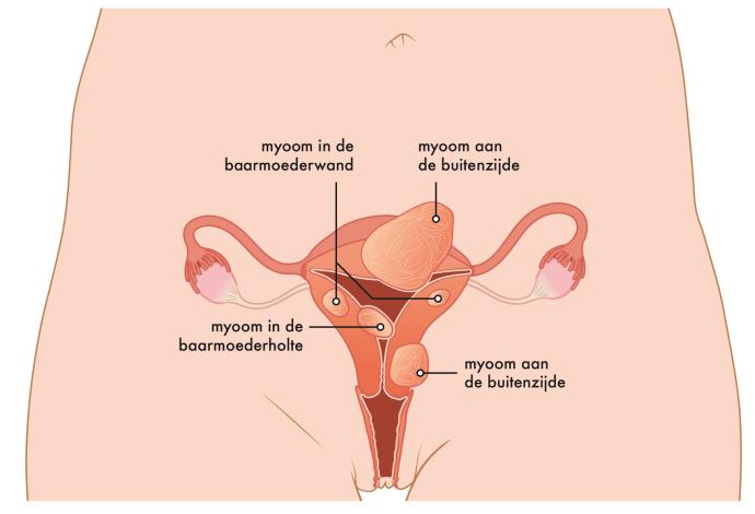 afbeelding van baarmoeder met vleesboom
