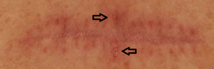 Basaalcelcarcinoom met in het litteken een groeiend bultje of zweertje 