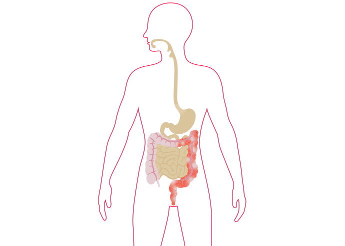 De afbeelding laat zien waar de ontstekingen bij colitis ulcerosa kunnen ontstaan in het maagdarmkanaal. 