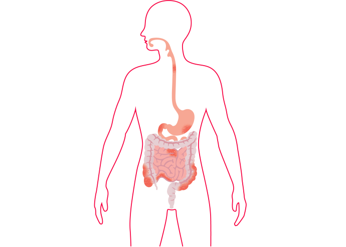 Deze afbeelding laat zien waar de ontstekingen bij crohn kunnen ontstaan in het maagdarmkanaal. 
